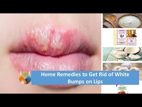 Home Remedies to Get Rid of White Bumps on Lips Home Remedies to Get Rid of White Bumps on Lips