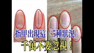 指甲出現這「5種狀況」千萬不要忽視！通過觀察指甲的狀態，就可知身體健不健康！一定要轉給親友知道！