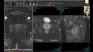 Prostate MRI MDM July 2020