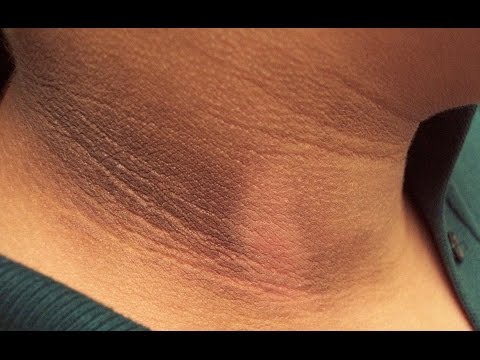 Dark Neck Home Remedy _ Quick Lightening & Whitening DIY _ SuperWowStyle Prachi Dark Neck Home Remedy _ Quick Lightening & Whitening DIY _ SuperWowStyle Prachi