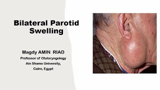 Bilateral Parotid Swellings