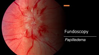 Papilledema: Fundoscopy