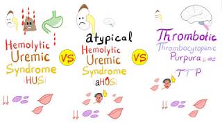 HUS vs aHUS vs TTP