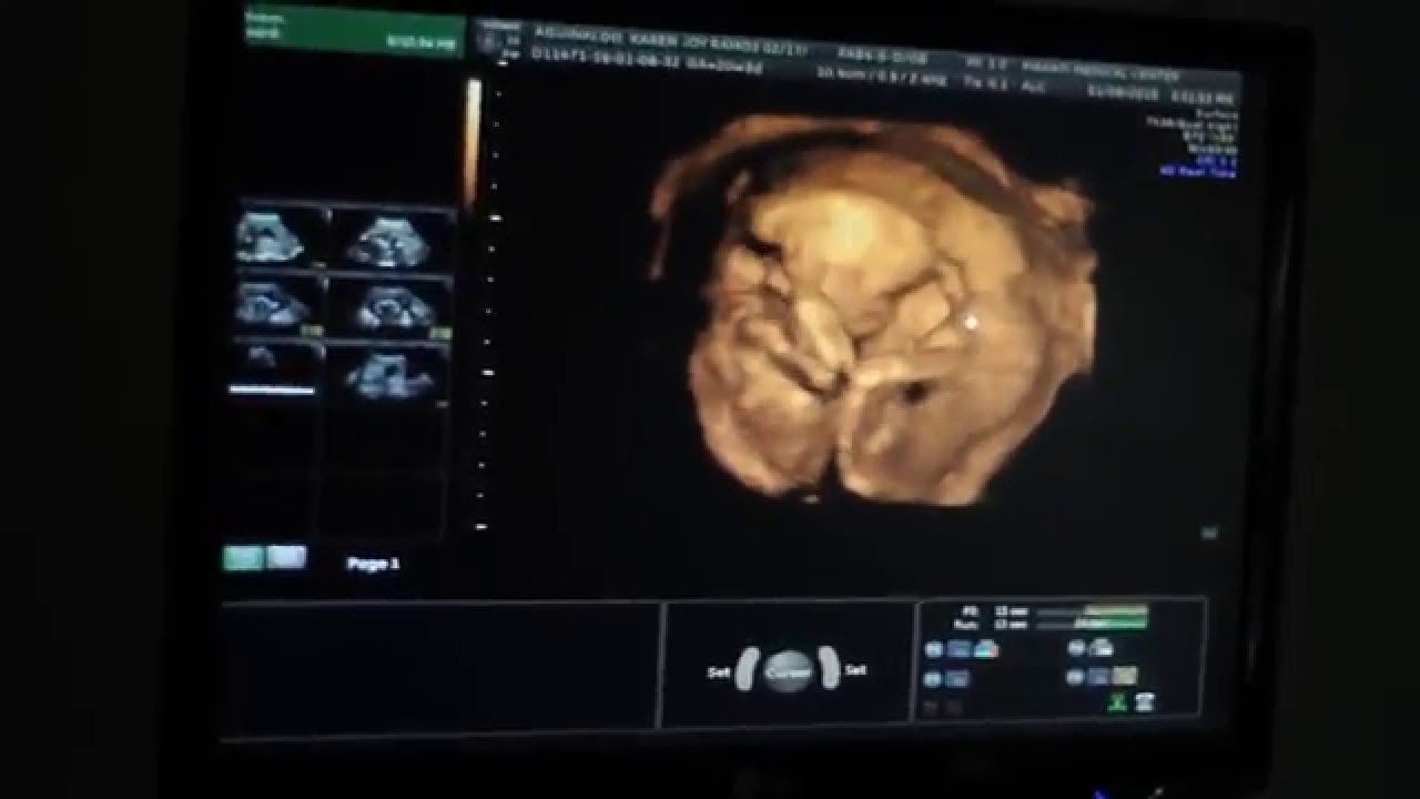 Congenital Anomaly Scan Congenital Anomaly Scan