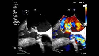 A rare complication of aortic valve endocarditis resulting from a regurgitant jet lesion