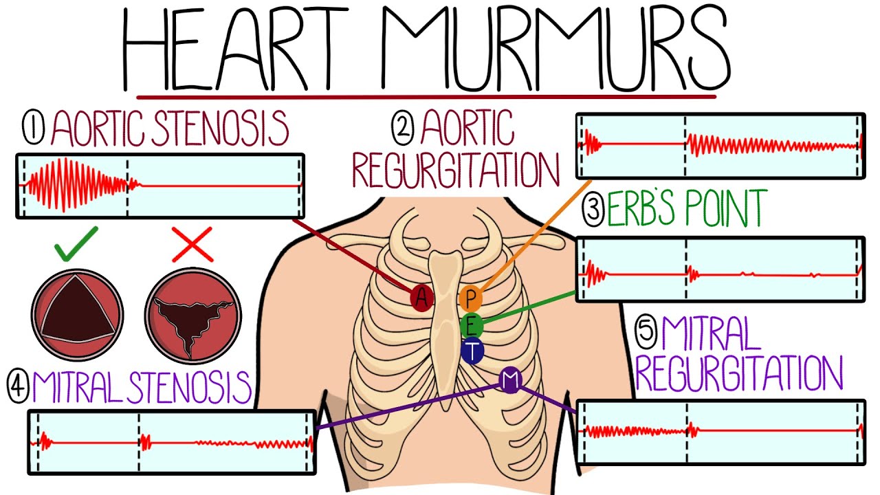 Understanding A Heart Murmur Heart Murmur Treatment Pcetsk