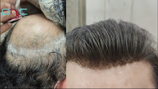 9899746489 Natural Hair Patch Service in Delhi | Amazing Frontline Hair Patch