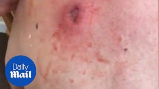 Gross moment a 25-year-old cyst is popped and oozes pus
