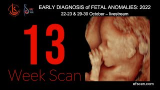 13 Week Scan - EARLY DIAGNOSIS of FETAL ANOMALIES 2022