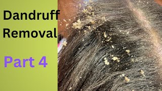 Dandruff Removal Part 4 | Huge Flakes