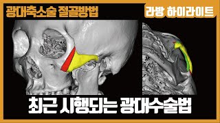 (SUB) 최근 시행되는 광대수술법의 문제점 [광대축소술 절골방법 #2] 最近施行される広大手術法の問題点 [広大縮小術の骨切り方法#2]