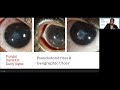 Lecture: Microbial Keratitis: Update for General Ophthalmologists