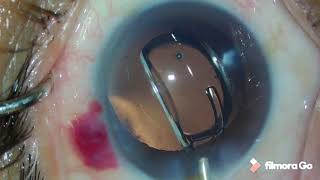 Tecnis Eyhance Implantation