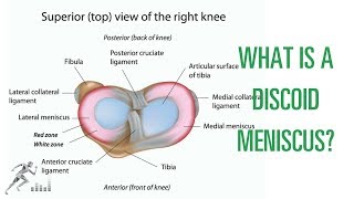 What is a discoid meniscus, and can you have them in both knees?