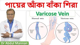 পায়ের আঁকা বাঁকা শিরা । ভেরিকোজ ভেইন । Varicose Vein । হোমিওপ্যাথিক চিকিৎসা । Dr Abdul Manana ।