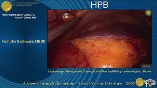 Laparoscopic Management of complicated liver hydatid cyst extending into thorax