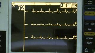 Normal Sinus Rhythm