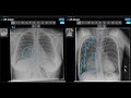 onlyscans radiology review indent vs. infection cracking the case of the tricky chest x ray