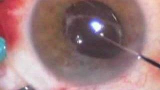 Macular pucker removal and repositioning of decentered IOL