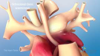 Hypoplastic Left Heart Syndrome (HLHS): Stage Two Procedure