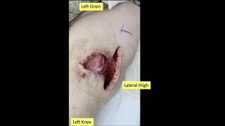 Presentation of an infected medial left leg wound