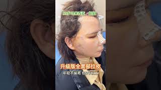 都是53岁，别人叫她姐姐，叫你阿姨，你会怎么想？#fyp #facelift #面部提升 #trending #plasticsurgery #整形 #拉皮 #Plastic #idol