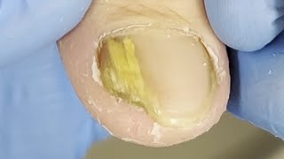 Clean Toenails & Treat Onychomycosis【Xue Yidao】