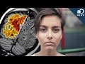 Can Alzheimer's Start In Your 20s? Can Alzheimer's Start In Your 20s?