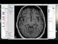 itk snap tutorial how to trace stroke lesions in t1w images