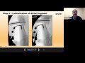 prostep mis refresher webinar mica solo guide with dr. pete mangone