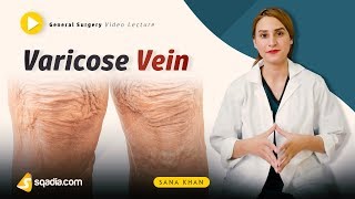 Varicose Vein | General Surgery | Video Lectures | Medical V-Learning | sqadia.com