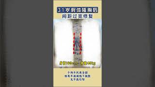 31岁求美者，假体隆胸后乳间距过宽不自然，无法形成乳沟，进行乳间距过宽修复！ #变美小技巧 #丰胸 #假体丰胸