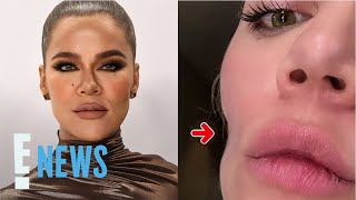 Khloé Kardashian Reveals Skin Cancer Removal Left Face Indentation | E! News