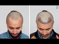 hair transplant in nanded best results u0026 cost of hair transplant in nanded