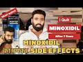 Minoxidil for Hairfall | My 7 Years Hair Transplant Result | How to Use minoxidil for Best Result