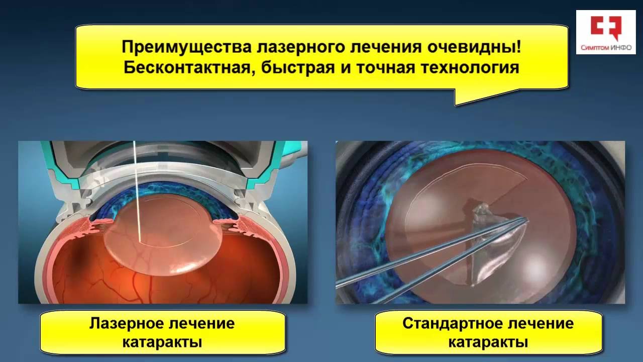 Замена хрусталика глаза как проходит операция. Факоэмульсификация катаракты лазером. Лазерная экстракция катаракты лазер. Экстракция катаракты операция.
