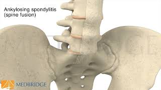 Ankylosing Spondylitis | MedBridge