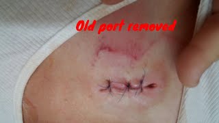 Bard Power Port Removal and New Power Port Implanted