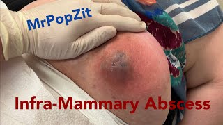 Infra-Mammary abscess. Large pocket of fluid drained with incision & drainage.