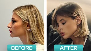 One Year After Rhinoplasty: The Stunning Transformation | Rhinoplasty in Turkey