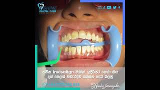 නවීන Invisalign මඟින්, ඉදිරියට නෙරා ගිය දත් පෙලක් නිවැරදිව සකසන හැටි බලමු...