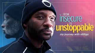 Living with Vitiligo: From Insecurity to Inspiration | WebMD