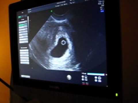 First Ultrasound at 6 weeks 3 days First Ultrasound at 6 weeks 3 days