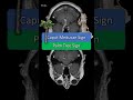 Neuroradiology Sign: Caput Medusae  #shorts