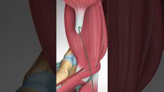 Distal Biceps Tendon Rupture and Repair  #bicepstendon #elbowpain #biceps