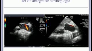 Dr Ian Harley: Anaesthesia \u0026 echocardiography during aortic valve replacement \u0026 repair