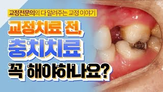 치아교정 치료전에 충치치료 먼저 해야하나요?