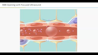 Webinar: Nir Lipsman, MD - Breaking Barriers with Sound: The Future of Parkinson's Disease Therapy