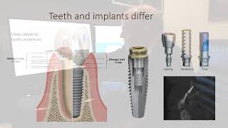 Dental Implants Introduction