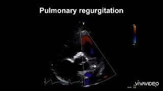 Pulmonary Regurgitation Echo